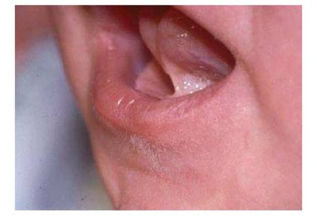 ¿Cómo afecta que el bebé tenga frenillo a la lactancia materna? frenilloCorazon2