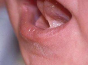 ¿Cómo afecta bebé tenga frenillo lactancia materna?