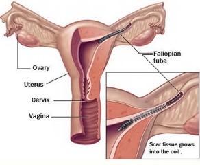 Essure bayer anticonceptivo daños