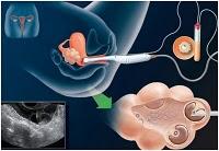 DOS DE CADA TRES FRACASAN EN LA FIV