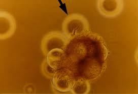 Deteccion del Cancer por Biopsia Liquida