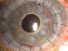 Desarrollan Cornea Bioartificial