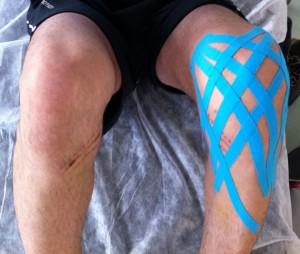 Ligamentoplastia tras rotura de ligamentoplastia