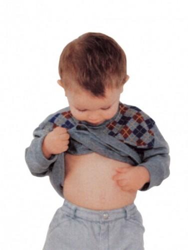 Niños con mucha panza