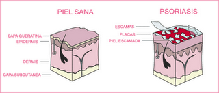 Abbott lanza una página web para facilitar a los pacientes de psoriasis información sobre su enfermedad