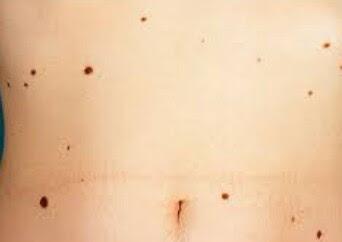 ¿Qué es un lunar común?