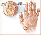 Osteoartritis Artricenter 