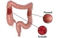 Síndrome intestino Irritable Artricenter