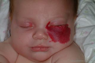 Manchas rojas en la piel del bebé. No todo son antojos
