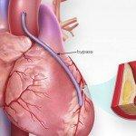 ECP: El nuevo método para la omisión coronaria de bypass