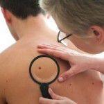 Cáncer de piel melanoma: Los síntomas y opciones de tratamiento