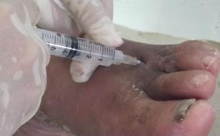 Las Tunas cada vez mejor en la atención a pacientes con úlcera del pie diabético