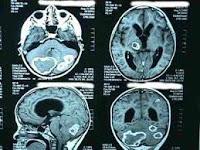 Uso de la Gliburida para tratar ACV