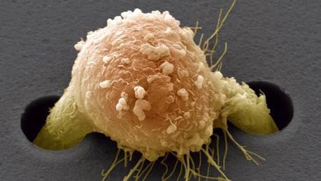 El implante-esponja contra el cáncer.