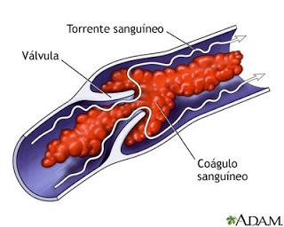 Información que salva vidas (concienciando sobre la trombosis)