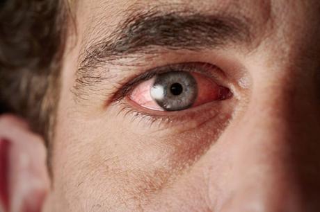 Cómo tratar la conjuntivitis y el glaucoma