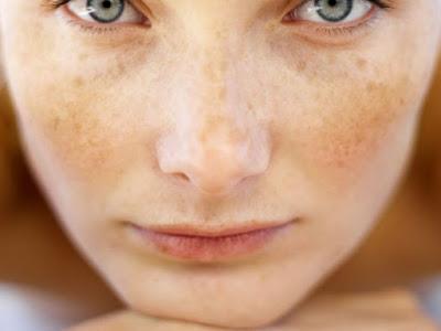 EMBARAZO Y MANCHAS FACIALES: CLOASMA GESTACIONAL