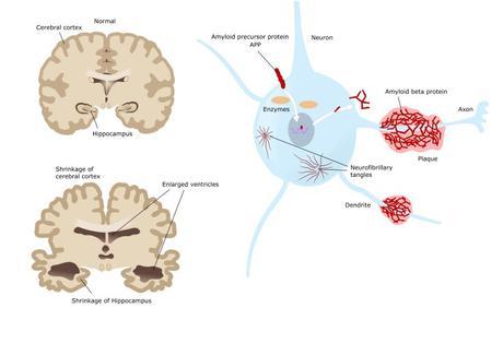 Demencias: tipos, síntomas, estadios, diagnóstico, tratamiento