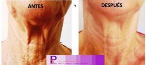 Experta en Tratamiento con Hilos Tensores:  Dra. Lourdes Pérez Soto.