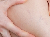 Prevenir varices mediante alimentación