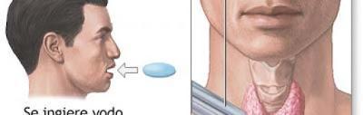Cáncer de tiroides y tratamiento con Yodo I-131