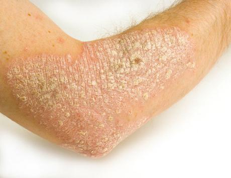 Las causas más comunes de la descamación de la piel