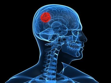 Una punción lumbar para detectar tumores cerebrales