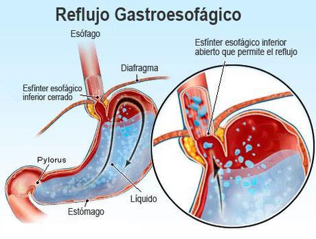 Tips para aliviar el reflujo de tu bebé