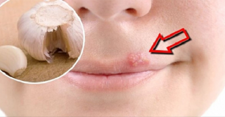 8 Remedios caseros para combatir el herpes labial