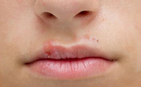 8 Remedios caseros para combatir el herpes labial