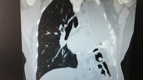 El monóxido de carbono, un 
