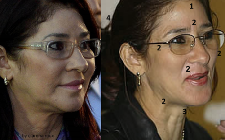 El botox de Cilia Flores