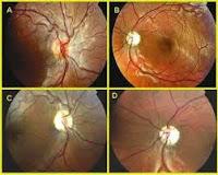 La Neuromielitis Optica