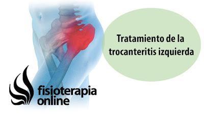 Bursitis trocanterea, qué es y cuales son sus causas y tratamiento