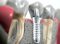 Pero, ¿Qué significa soñar con un implante? sueño con un implante