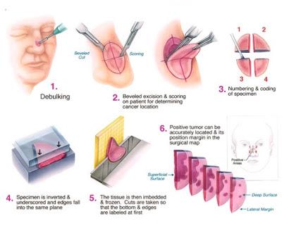 CIRUGÍA DE MOHS: EL MEJOR TRATAMIENTO PARA EL CÁNCER DE PIEL QUE EL DERMATÓLOGO REALIZA CON OTROS ESPECIALISTAS