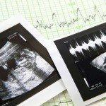 Un nuevo proyecto de ley de Ohio puede, impedir el aborto de su bebé simplemente porque el niño tiene un cromosoma extra