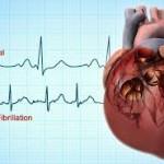 Stroke Prevention in Atrial Fibrillation