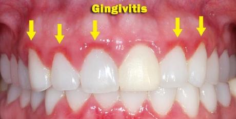 gingivitis