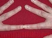 dedo índice cáncer próstata