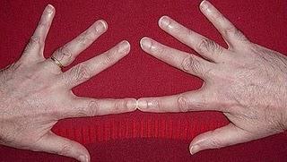 El dedo índice y el cáncer de próstata