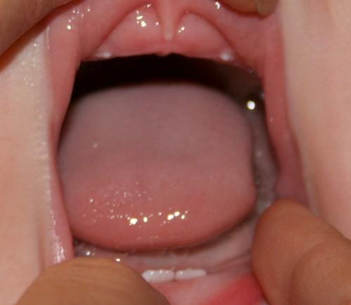 Dientes en los recien nacidos