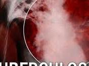 Pandemia Mundial Tuberculosis