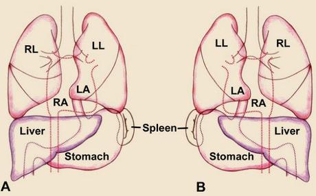 Situs Inversus