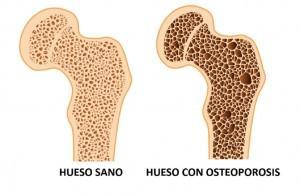 Como identificar y prevenir el déficit de vitamina D