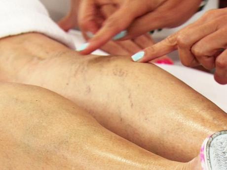 5 remedios caseros para eliminar las varices o arañitas en las piernas: