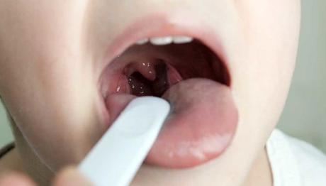 12 Excelentes remedios caseros para curar la amigdalitis