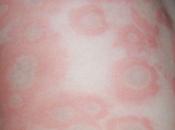 eficaces remedios caseros para urticaria