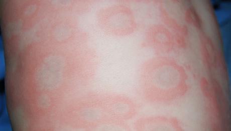 10 eficaces remedios caseros para la urticaria
