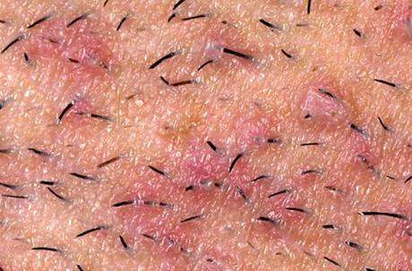 Marcas oscuras y cicatrices de pelos encarnados e irritación en la región púbica